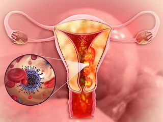 Endometrial-Cancer-1-320x240