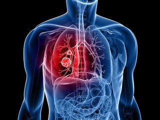 Lung-Cancer-1-1-320x240
