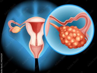 Ovarian-Cancer-320x240