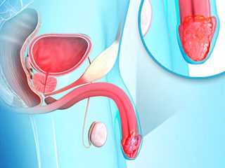 Penile-Cancer-320x240