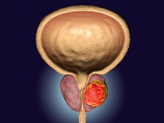 Prostate-Cancer-2-1-320x240