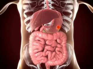 Stomach-Cancer-2-320x240