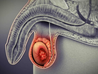 Testicular-Cancer-320x240