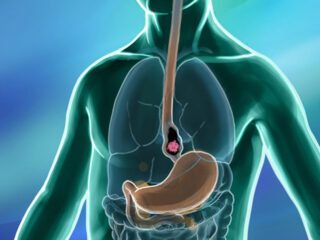 esophageal-cancer-320x240