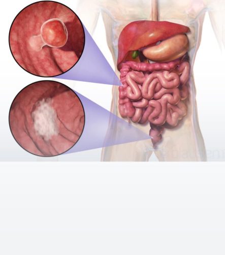 Causes-of-Colorectal-Cancer-1-640x723